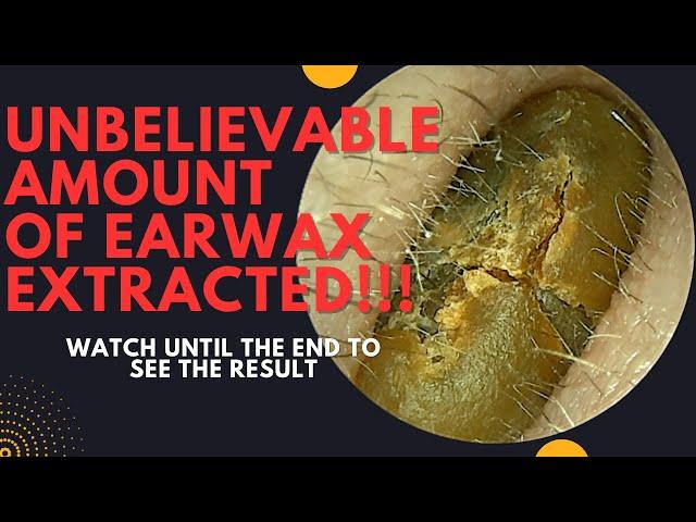 UNBELIEVABLE Amount Of Earwax Extracted From This Ear!!! (Watch Until The End)