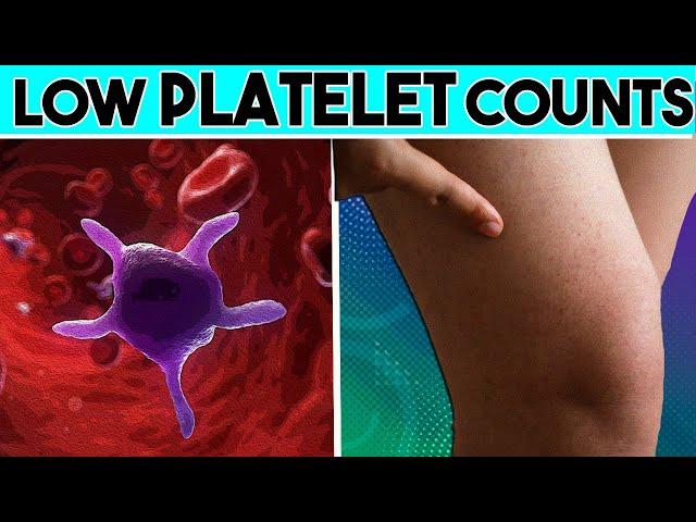 Causes, Signs and symptoms of Low platelet count |Thrombocytopenia | Low Platelet count