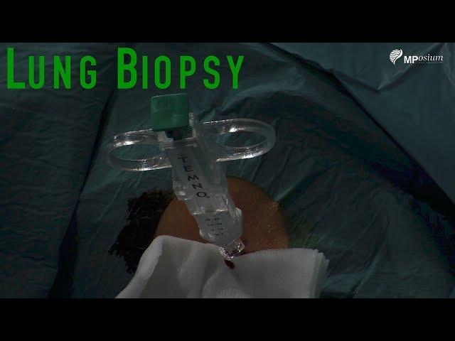 Lung biopsy