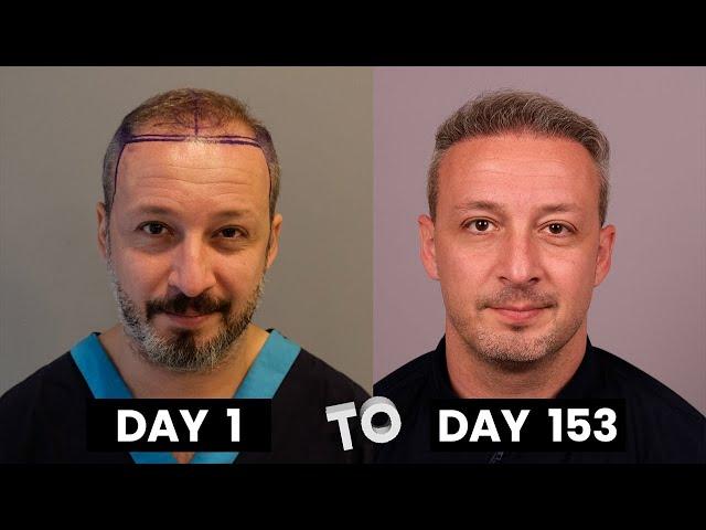 HAIR TRANSPLANT TIMELAPSE | DAY 1 TO DAY 153 | GROWTH IN 5 MONTHS |  BEFORE & AFTER