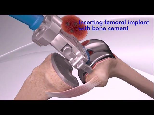 Total Knee Replacement TKR   Animation