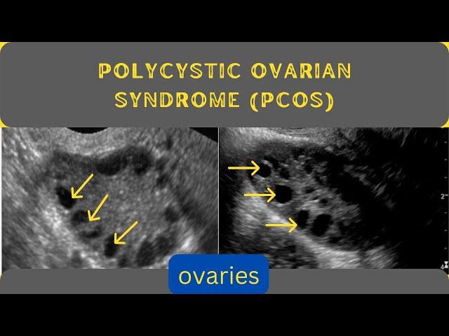 Enlarged Ovaries | Polycystic Ovarian syndrome (PCOS) | Ultrasound