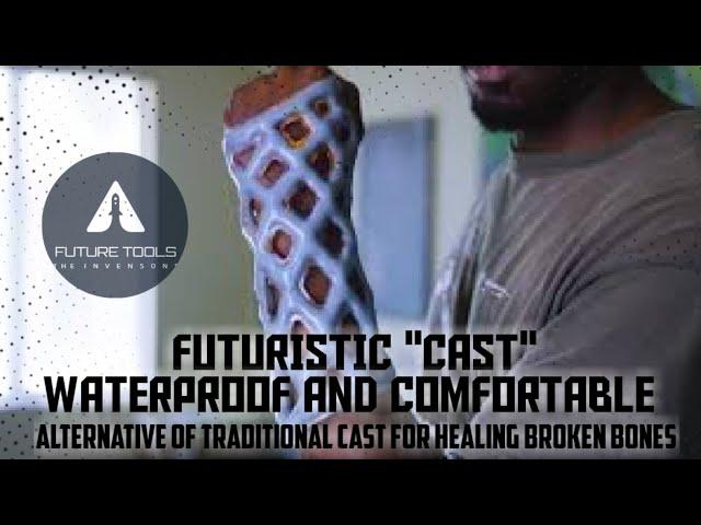 futuristic cast | waterproof cast | alternative of traditional cast for healing broken bones