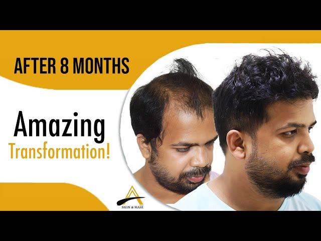 Hair Transplant (4130 grafts NW V) 8 months result by @alloroots