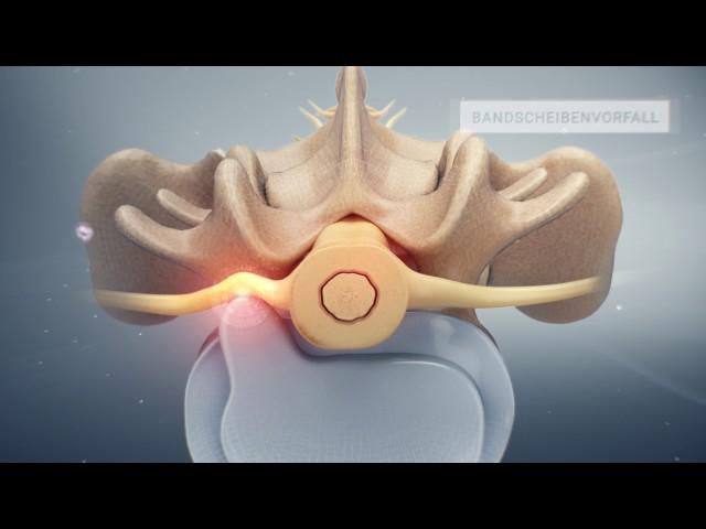 «Rückenschmerzen – Infiltration an der Lendenwirbelsäule» - Schulthess Klinik