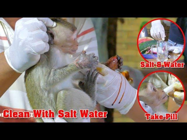 VO's Start Cleaning Janet Hands By Using Salt & Hot Water That Can Help More Dry Her Hand - MB 529