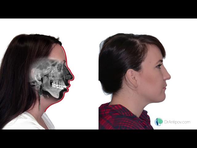 Jaw Surgery, a look at the before and after - Case 4