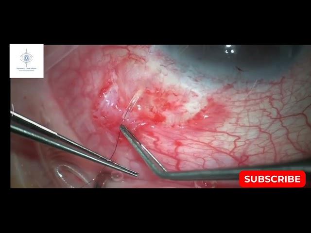 PreserFlo MicroShunt Rescue with Nylon 9-0 @ocnseyecare_official #JaivalSheth #ocns