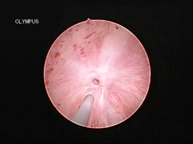 Optical urethrotomy