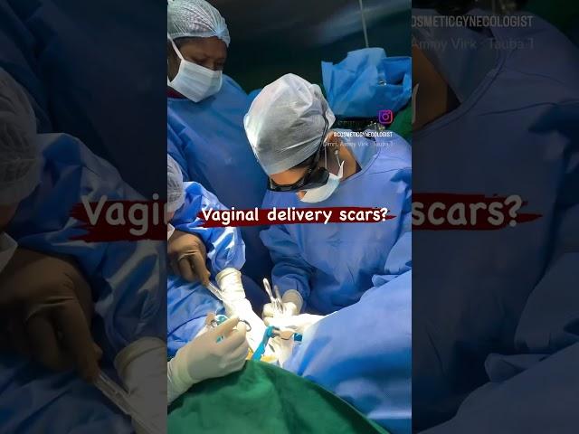 Vaginal delivery scar removal / Dr. Deepa Ganesh / Cosmetic Gynecologist