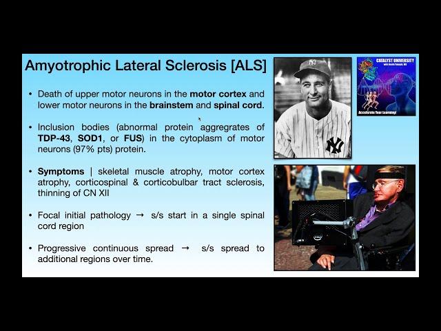 Amyotrophic Lateral Sclerosis [ALS] | Basics & Clinical Presentation