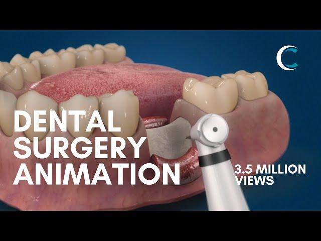 Dental Surgery Animation - Bone Grafting