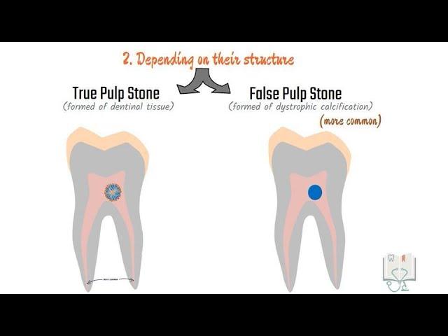 Pulp stones (Denticles) #pulp #dental