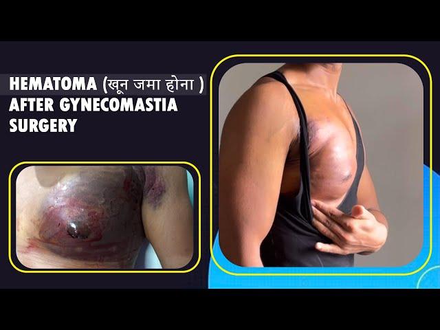 What is HEMATOMA (खून जमा होना )  After Gynecomastia Surgery