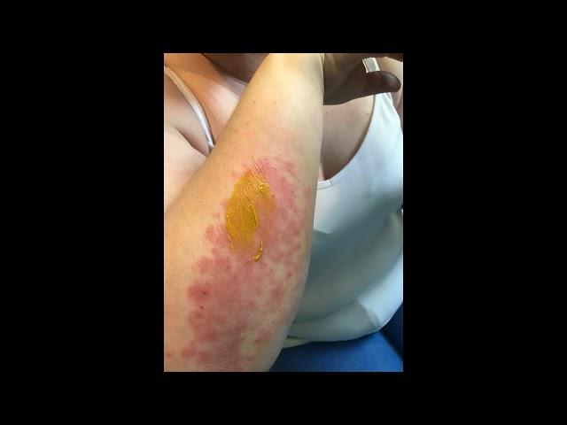 Psoriasis Cream Drug and Steroid Free