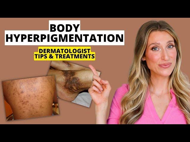 Dermatologist Explains Body Hyperpigmentation: What Causes It, Best Treatments, Prevention, & More!