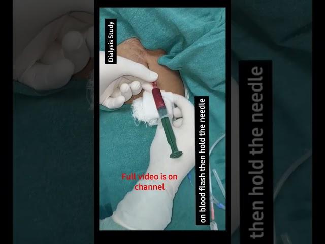 Femoral line catheterization Procedure |Vascular access for dialysis |Femoral central line Procedure