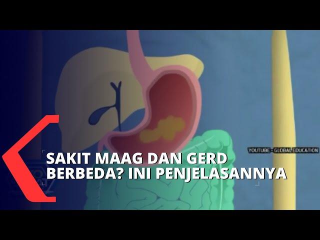 Apa Perbedaan Maag dan Gerd? Begini Penjelasannya