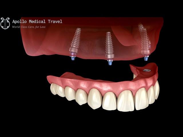 Animated Implant Supported Denture Procedure | Apollo Medical Travel