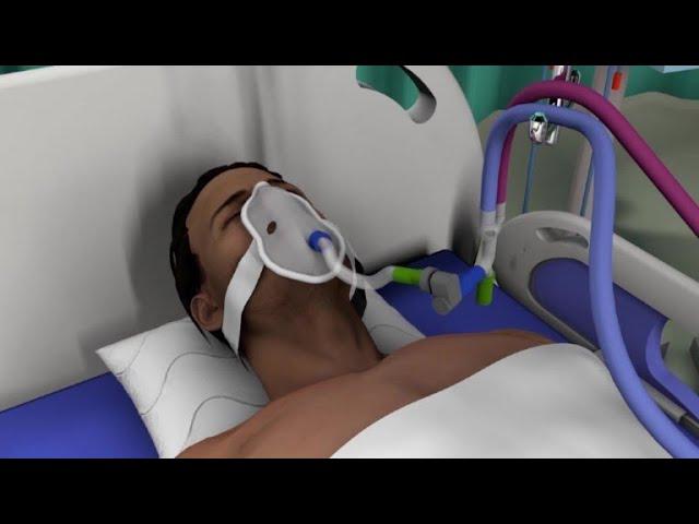 Fonctionnement d'un respirateur artificiel | AFP