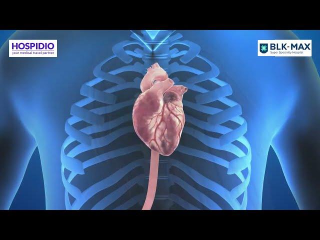 Transcatheter Aortic Valve Implantation TAVI procedure explained by BLK-Max | HOSPIDIO