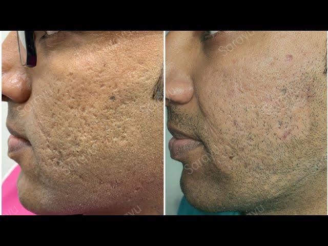 Acne Scar Treatment Fractional CO2 Laser, Subcision, MnRF with Vampire Facial(Face PRP) #Short