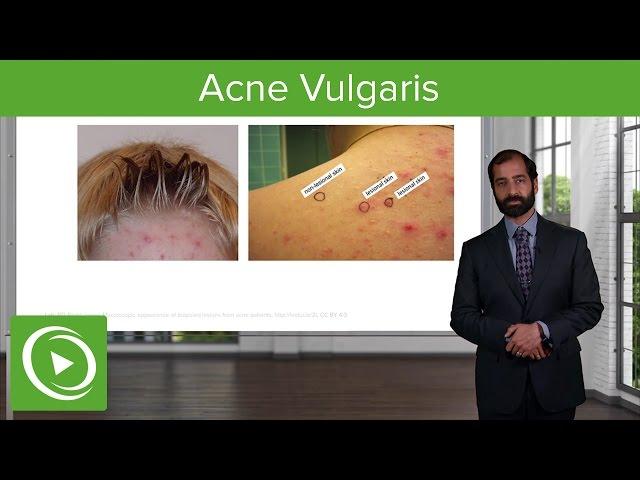 Inflammatory Skin Diseases: Acne Vulgaris – Pathology | Lecturio