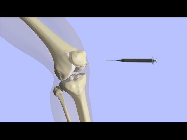 Knee Joint Injection