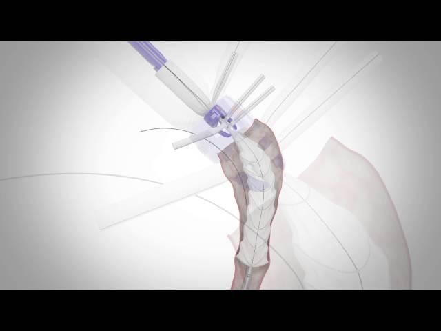 Vascutek Thoraflex Hybrid Animation