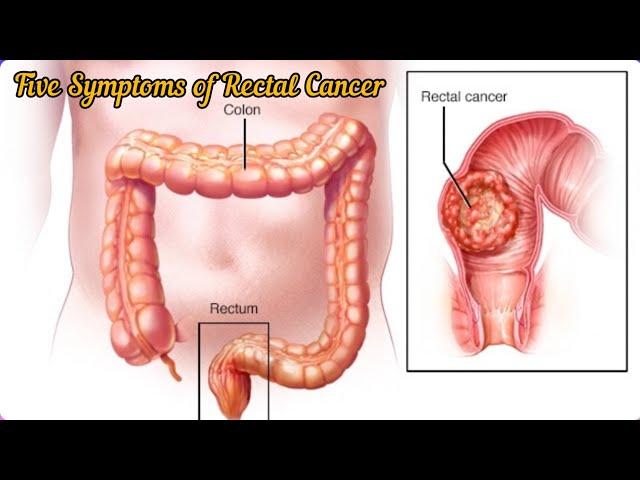 Five common symptoms of Rectal cancer @DrAshishSachan