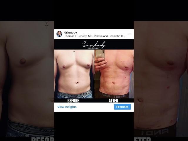 Before and after | Male breast Gynecomastia + Ab etching Before and after surgery |  Dr Jeneby