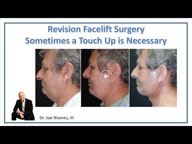 Revision Facelift Surgery:  Sometimes You Need a Touch Up  #deepplanefacelift #revisionfacelift