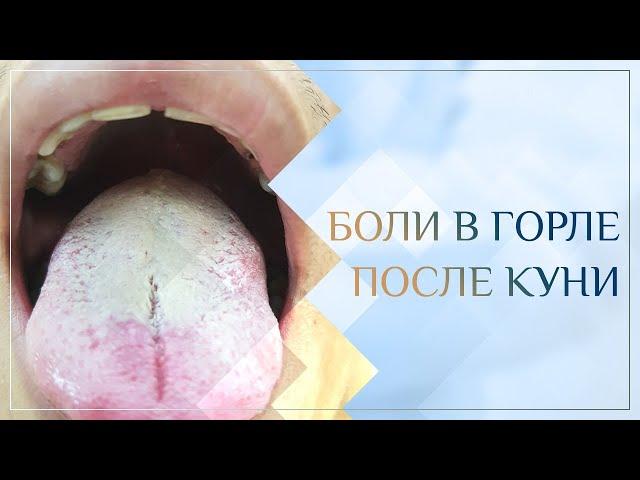  Боли в горле после куни. Клинический случай №20