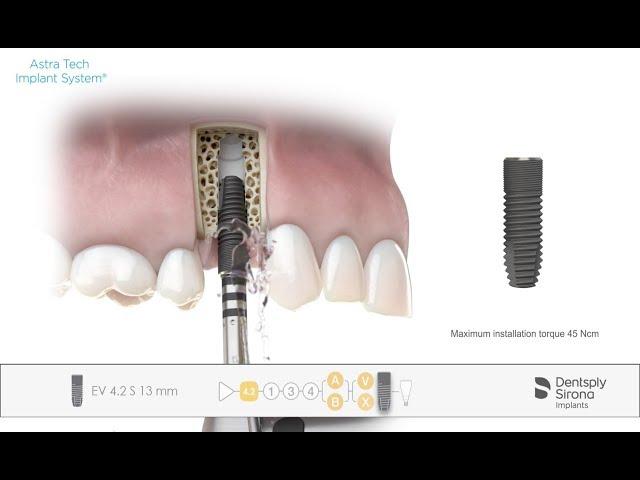 Implant installation Astra Tech Implant System EV