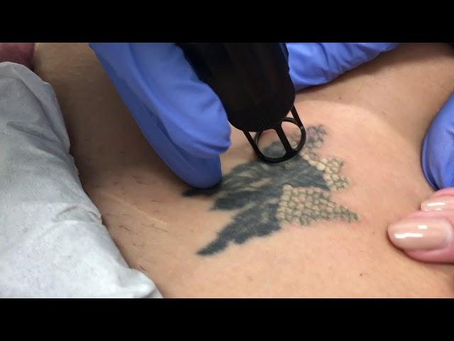 Laser Tattoo Removal