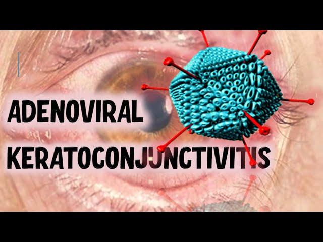 VIRAL CONJUNCTIVITIS | Ultimate Guide to Recognising Clinical Presentations