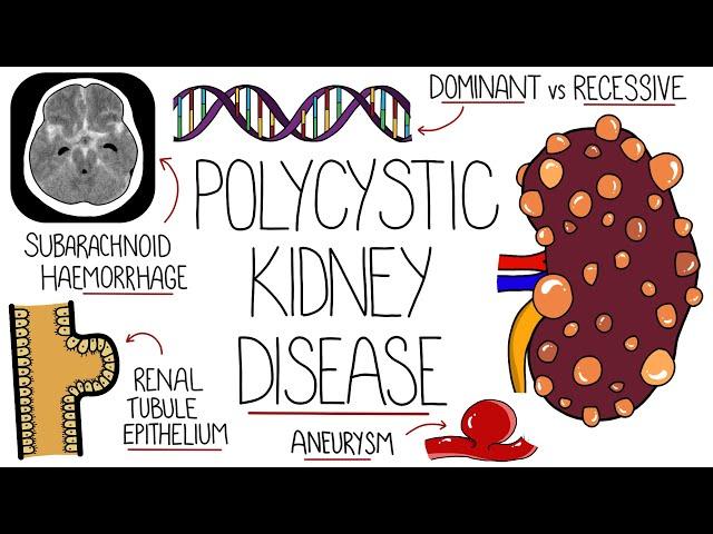 Polycystic Kidney Disease Explained