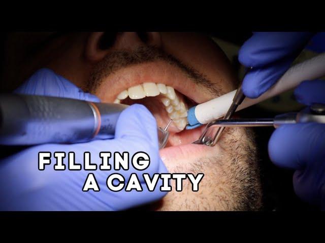 How Does A Dentist Fill A Cavity?