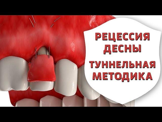 Оголились корни зубов? Лечение рецессии десны туннельной методикой | Дентал ТВ