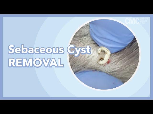 Sebaceous Cyst Removal