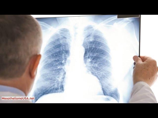 5 Year Survival Mesothelioma - What is Survival Rates of Mesothelioma?