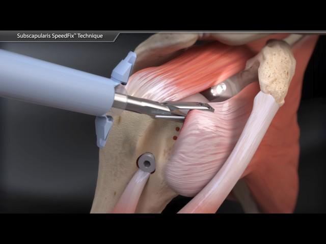 Subscapularis SpeedFix™ Technique