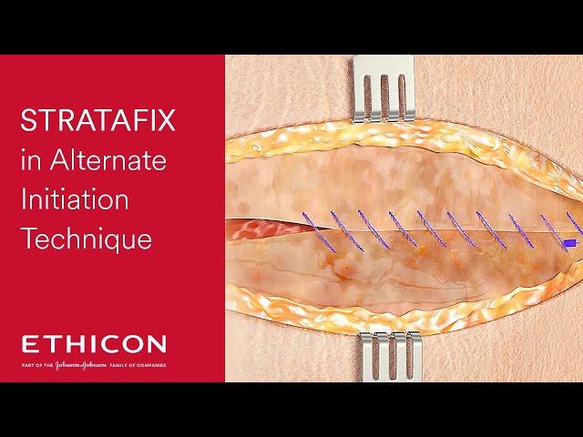 STRATAFIX Symmetric PDS Plus Alternate Initiation Suturing Technique | Ethicon