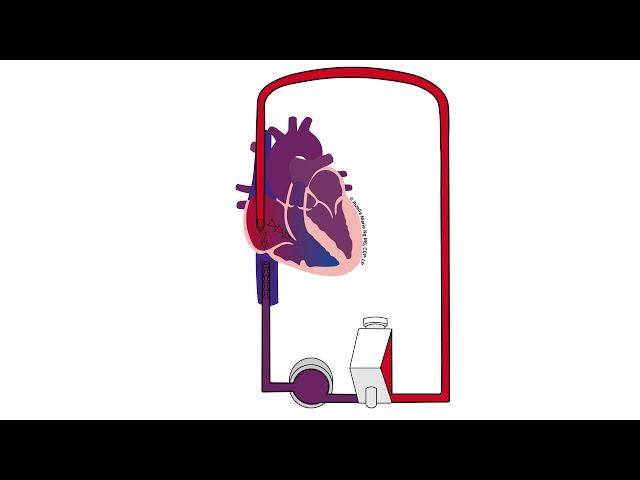 Recirculation on VV ECMO