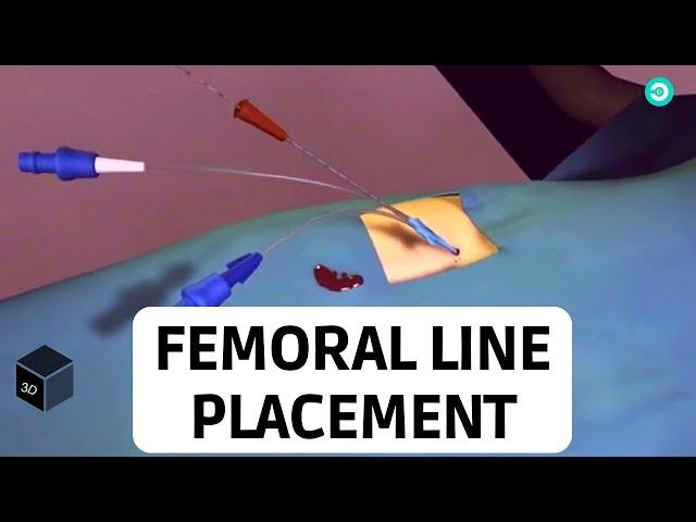 Central Line placement (Femoral Vein): Medical animation