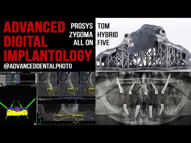 All on 5 / Zygoma hybrid / Prosystom