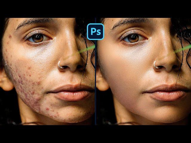 ACNE REMOVAL  Photoshop Tutorial