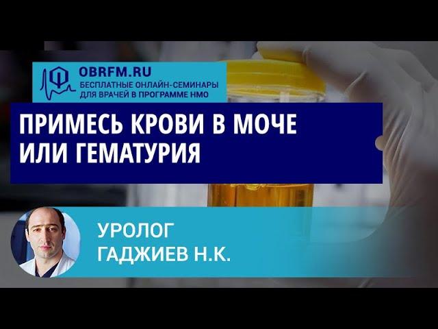 Уролог Гаджиев Н.К.: Примесь крови в моче или гематурия