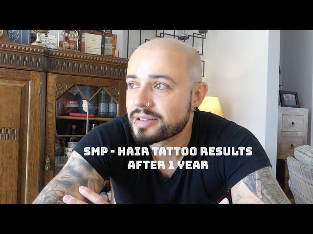 Scalp Micro Pigmentation  (SMP) after 1 year