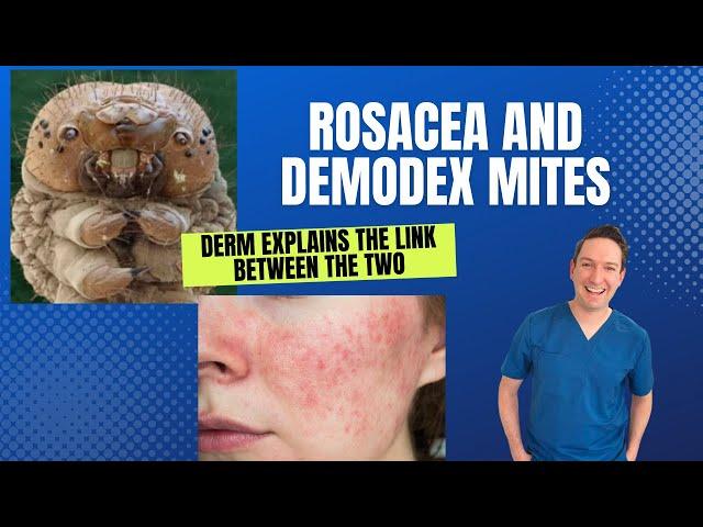 Dermatologist explains: Rosacea and the link with Demodex Mites: What can be done? #Rosacea #demodex